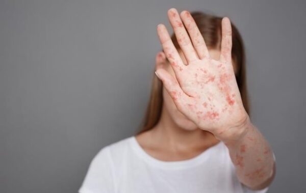 Захворюваність на кір в Україні зросла удесятеро